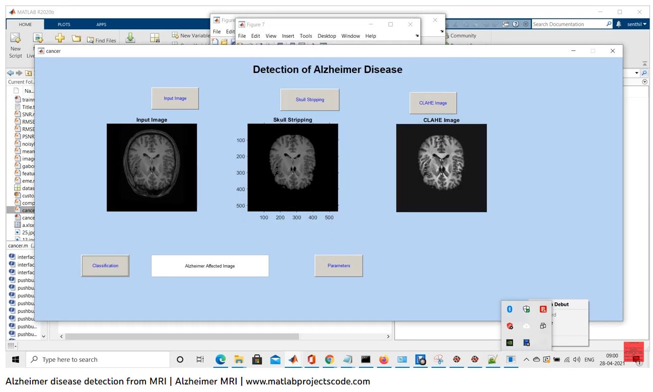 Alzheimer Disease Detection From Mri _ Alzheimer Mri project thumbnail image