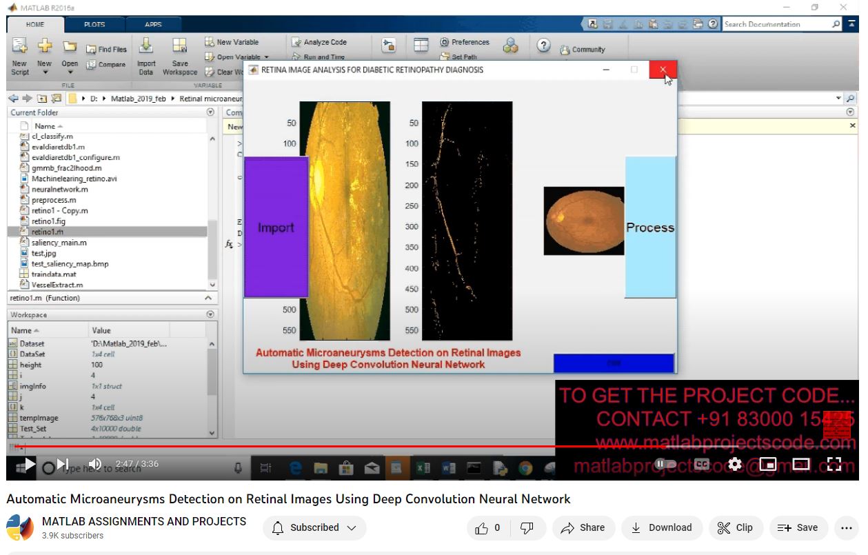 Automatic Microaneurysms Detection On Retinal Images Using Deep Convolution Neural Network project thumbnail image