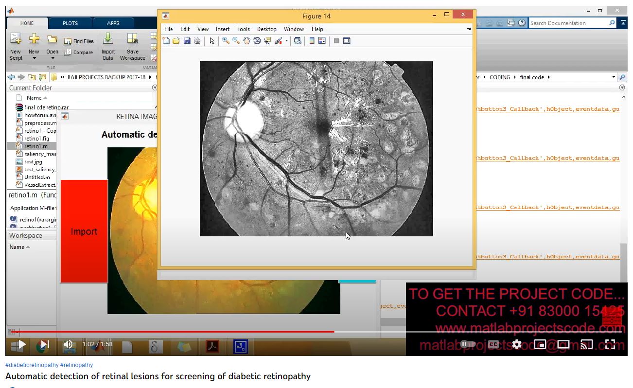 Automatic Detection of Retinal Lesions for Screening of Diabetic Retinopathy project thumbnail image
