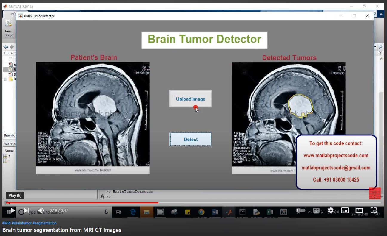 Brain Tumor Segmentation from MRI CT Images project thumbnail image