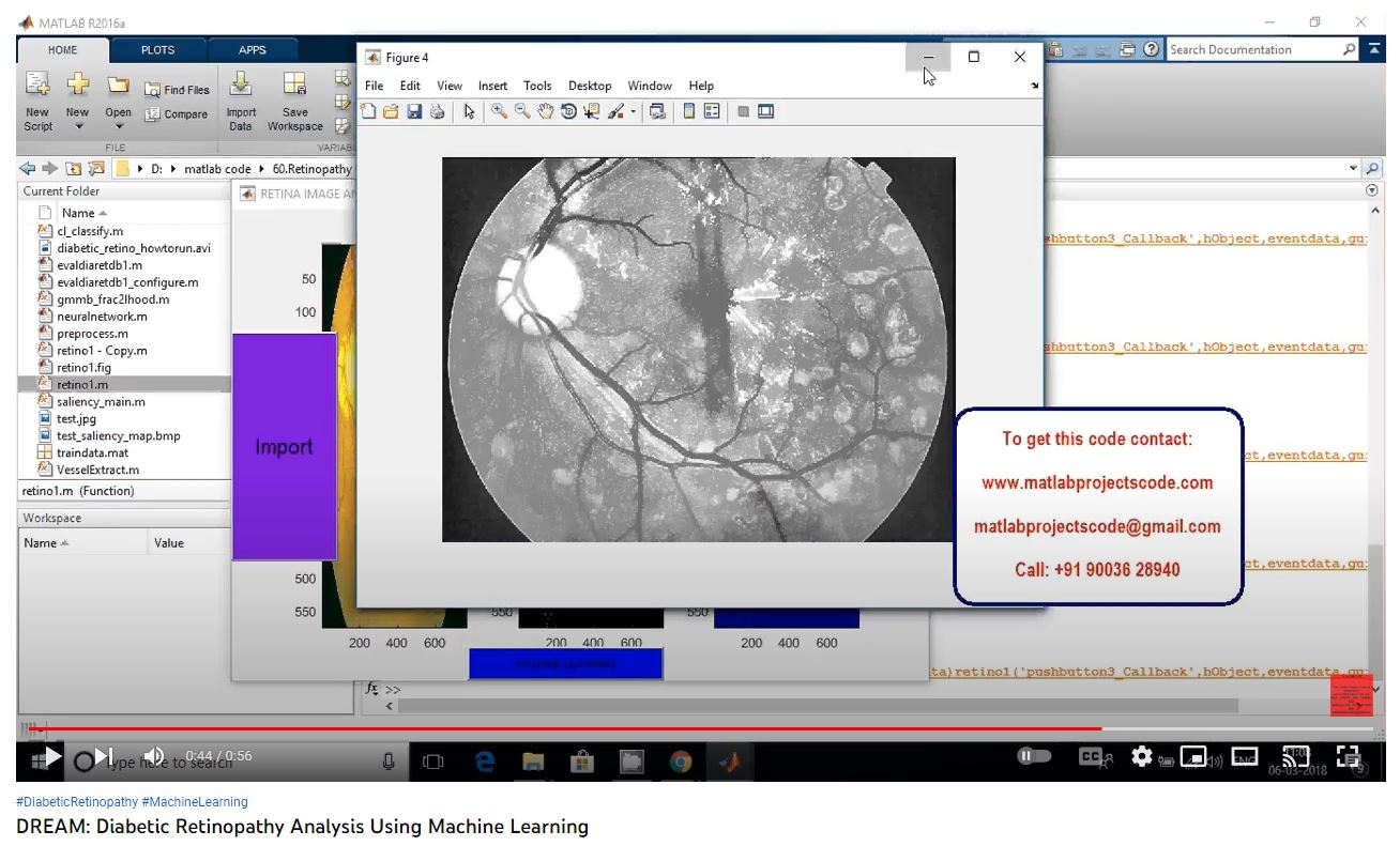 Diabetic Retinopathy Analysis using Machine Learning project thumbnail image