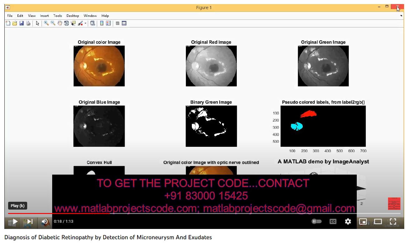 Diagnosis of Diabetic Retinopathy by Detection of Microneurysm and Exudates project thumbnail image
