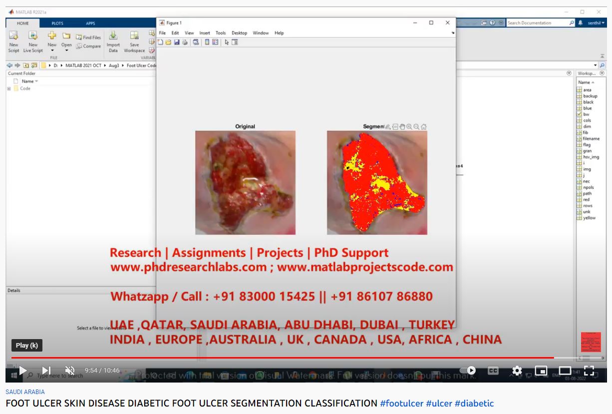 FOOT ULCER SKIN DISEASE - DIABETIC FOOT ULCER SEGMENTATION CLASSIFICATION-MATLAB Assignments project thumbnail image