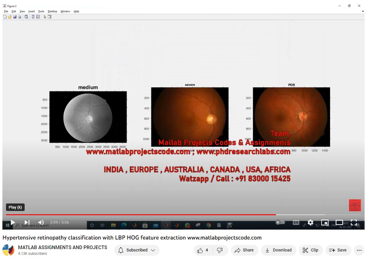 Hypertensive Retinopathy Classification With Lbp Hog Feature Extraction project thumbnail image