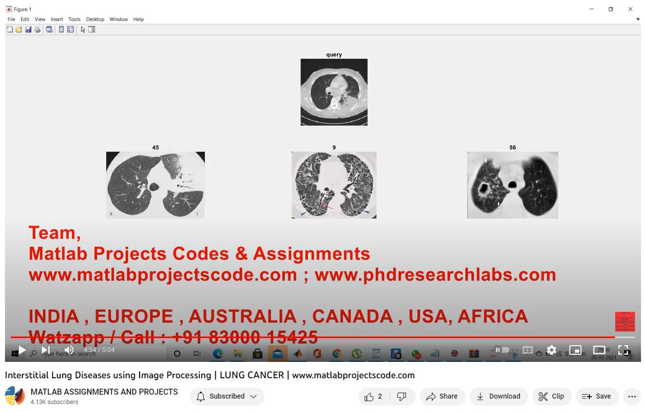 Interstitial Lung Diseases Using Image Processing _ Lung Cancer project thumbnail image
