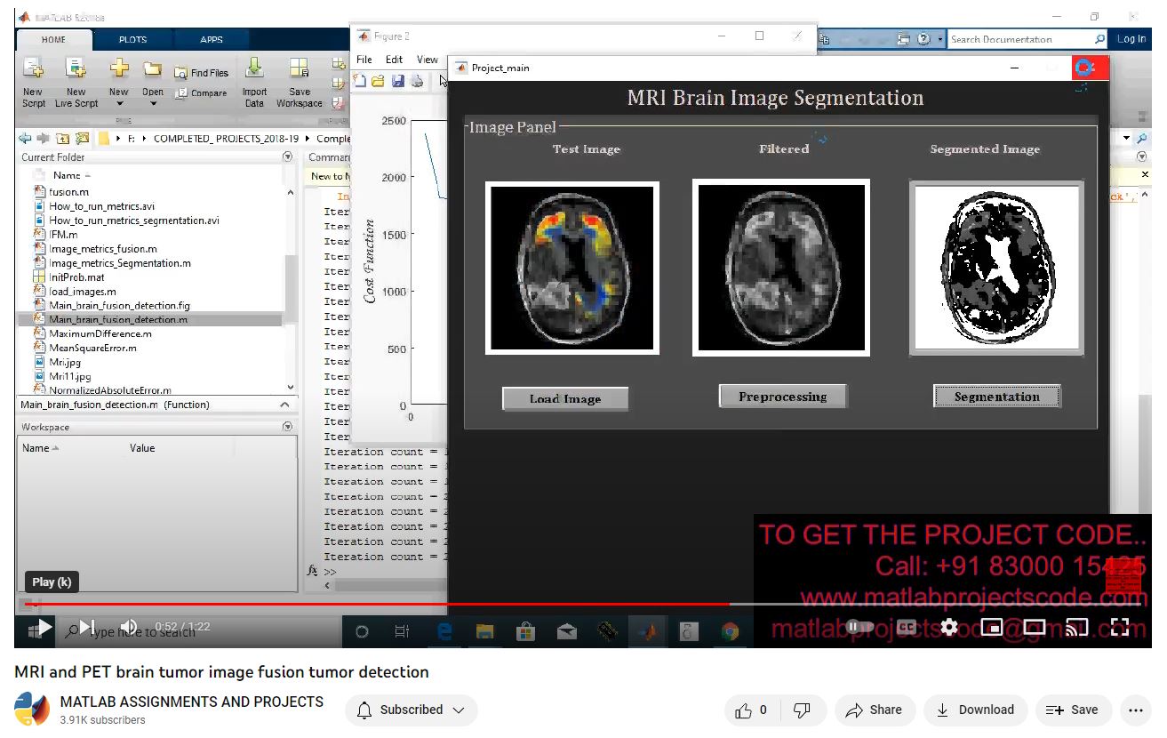 Mri And Pet Brain Tumor Image Fusion Tumor Detection project thumbnail image