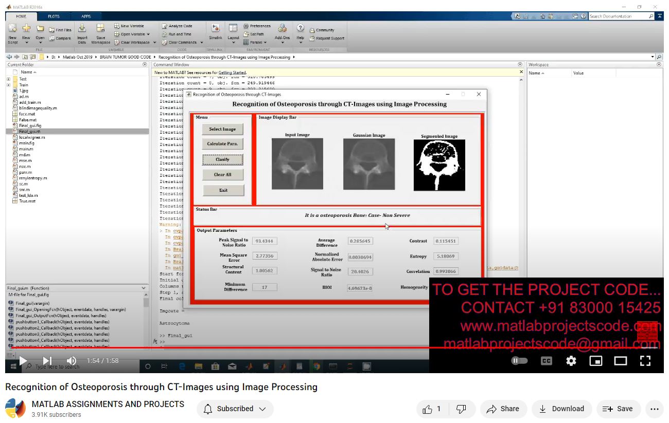 Recognition Of Osteoporosis Through Ct-Images Using Image Processing project thumbnail image