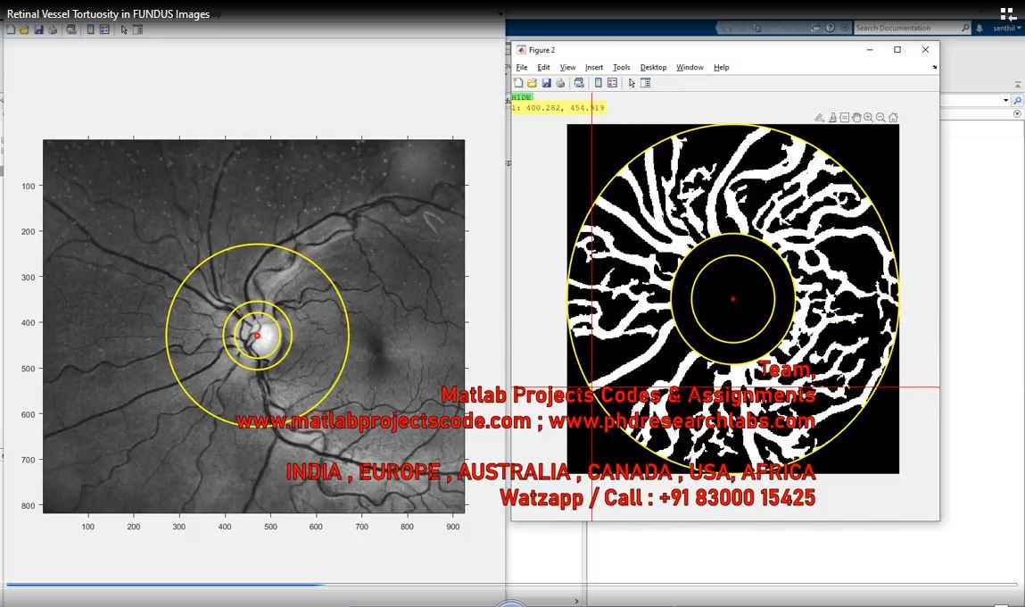 Retinal Vessel Tortuosity In Fundus Images project thumbnail image