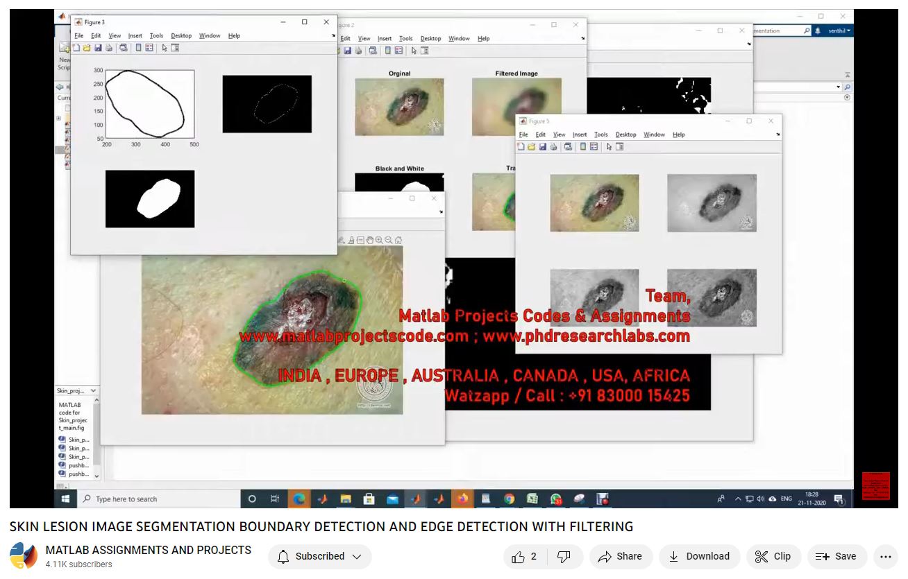Skin Lesion Image Segmentation Boundary Detection And Edge Detection With Filtering-Matlab Simulink-Electrical Assignments-Projects-Phd Research project thumbnail image