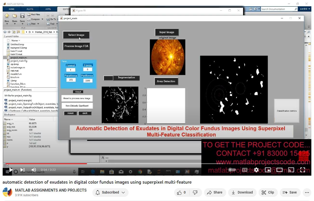 Automatic Detection Of Exudates In Digital Color Fundus Images Using Superpixel Multi-Feature project thumbnail image