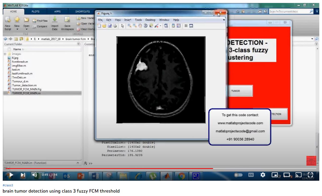 Brain Tumor Detection using Class 3 Fuzzy FCM Threshold project thumbnail image